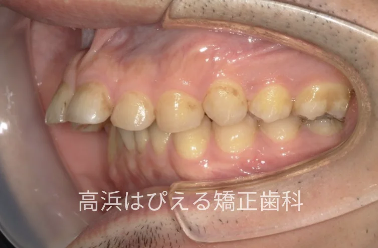 41歳男性の重度の出っ歯の治療前の左側面口腔内写真