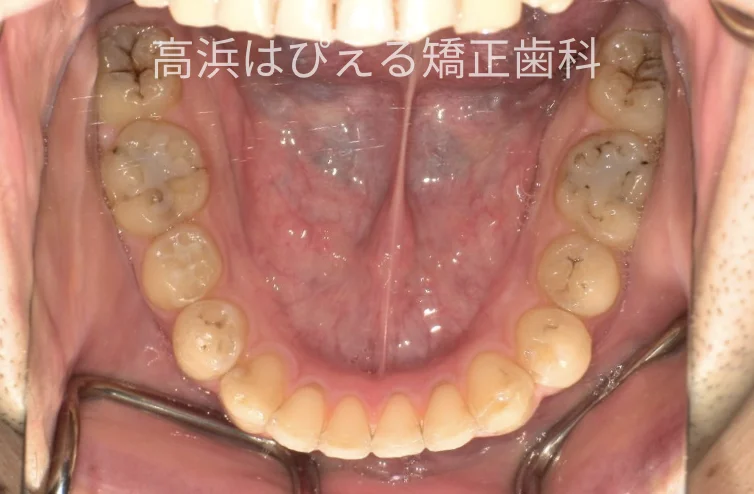 41歳男性の重度の出っ歯の治療後の下顎咬合面口腔内写真