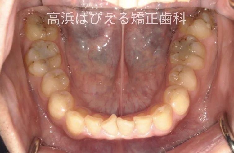 41歳男性の重度の出っ歯の治療前の下顎咬合面口腔内写真