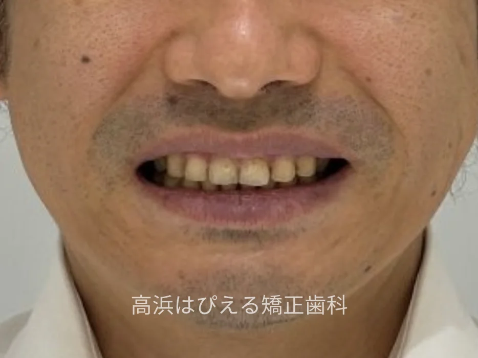 41歳男性の重度の出っ歯症例の治療後の口元写真