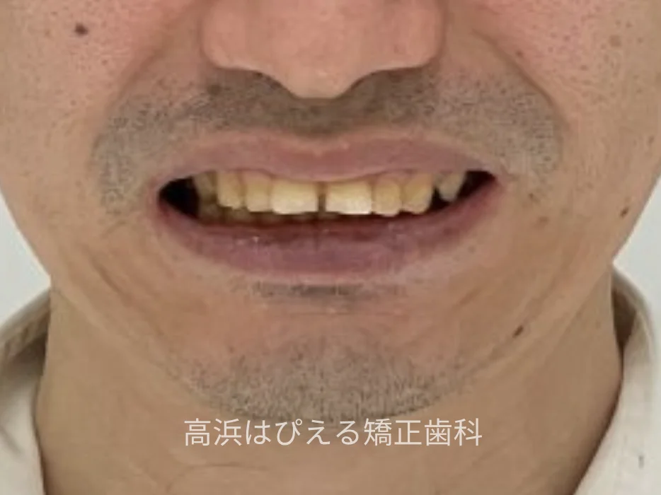 41歳男性の重度の出っ歯症例の治療前の口元写真