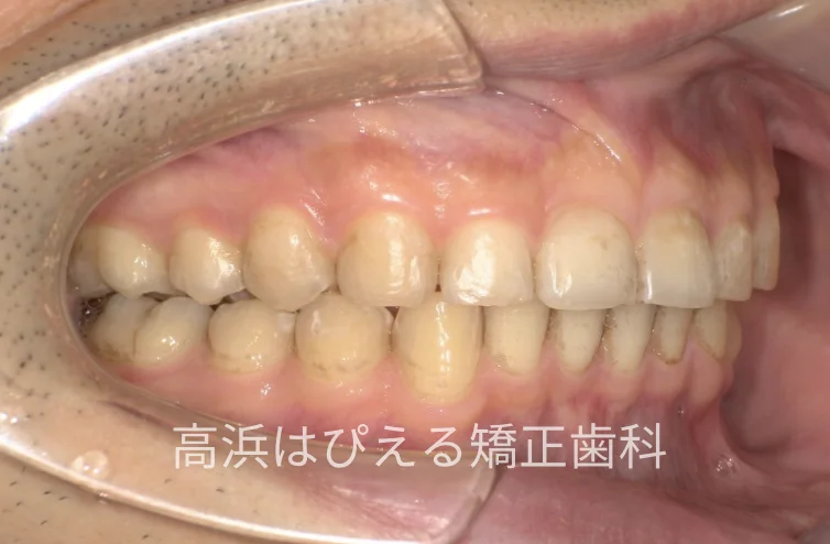 41歳男性の重度の出っ歯の治療後の右側面口腔内写真