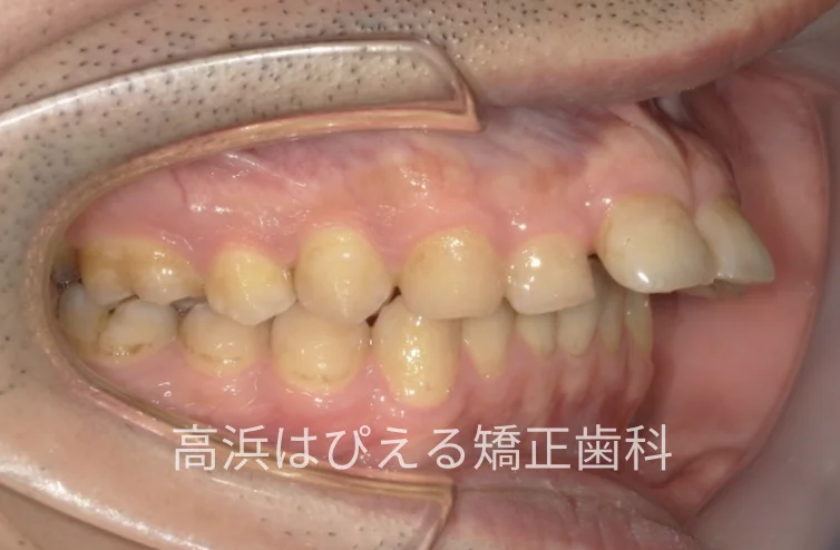 41歳男性の重度の出っ歯の治療前の右側面口腔内写真