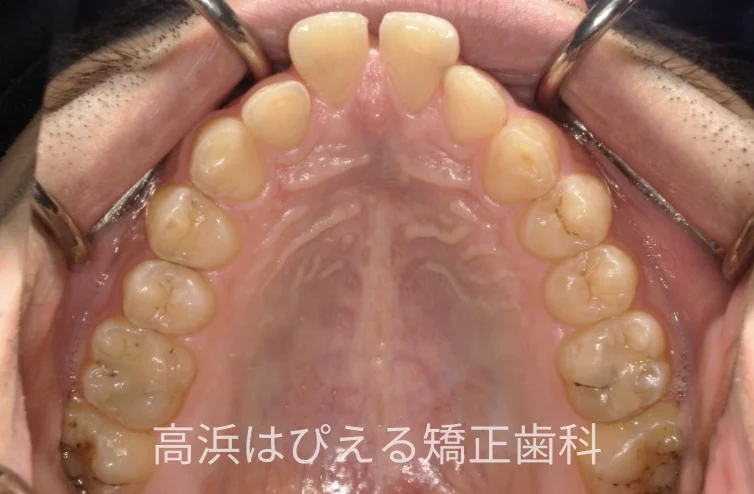 41歳男性の重度の出っ歯の治療前の上顎咬合面口腔内写真