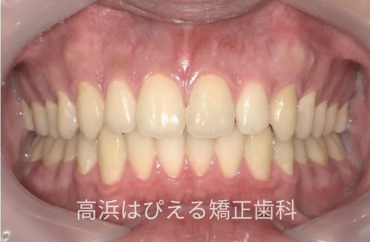 15歳男子の出っ歯・深い噛み合わせの治療後の正面口腔内写真