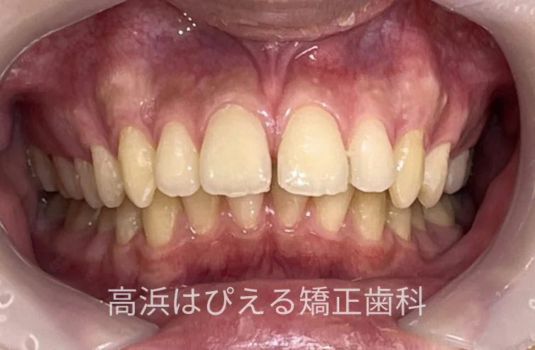 15歳男子の出っ歯・深い噛み合わせの治療前の正面口腔内写真