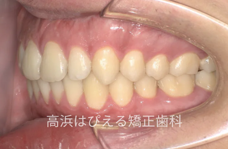 15歳男子の出っ歯・深い噛み合わせ症例の治療後の左側面口腔内写真
