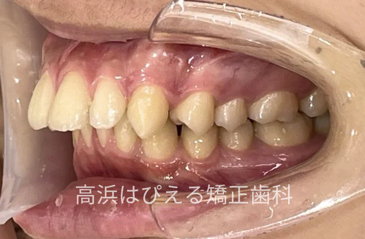 15歳男子の出っ歯・深い噛み合わせ症例の治療前の左側面口腔内写真