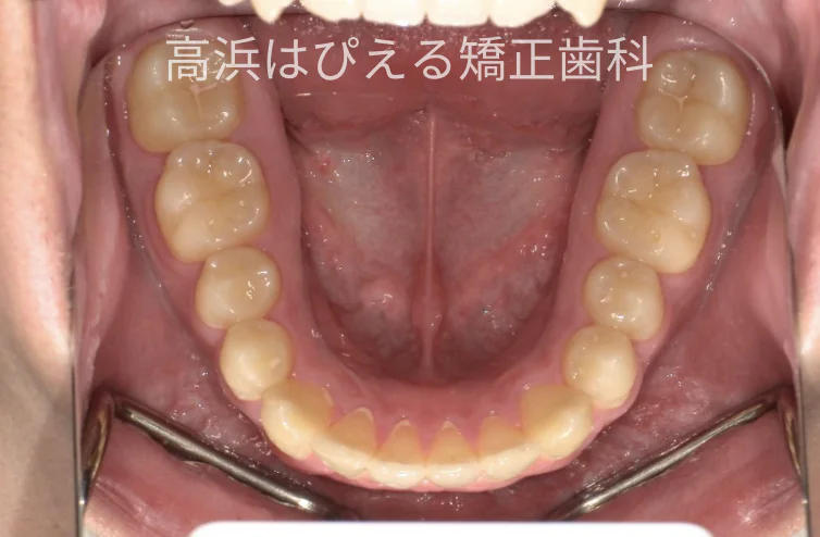 15歳男子の出っ歯・深い噛み合わせ症例の治療後の下顎咬合面口腔内写真