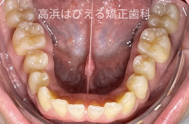 15歳男子の出っ歯・深い噛み合わせ症例の治療前の下顎咬合面口腔内写真