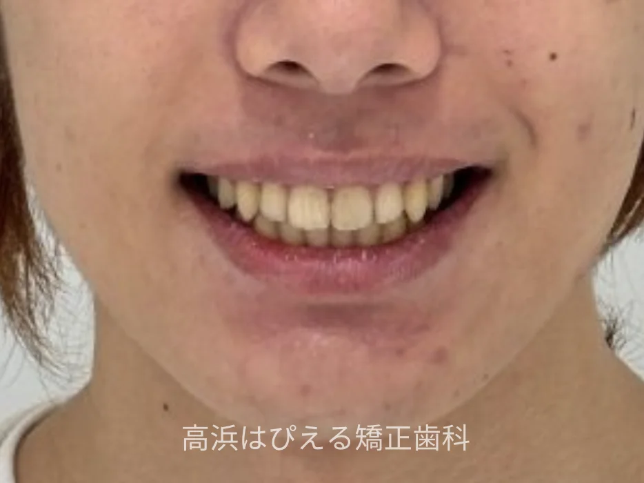 15歳男子の出っ歯・深い噛み合わせ症例の治療後の口元写真