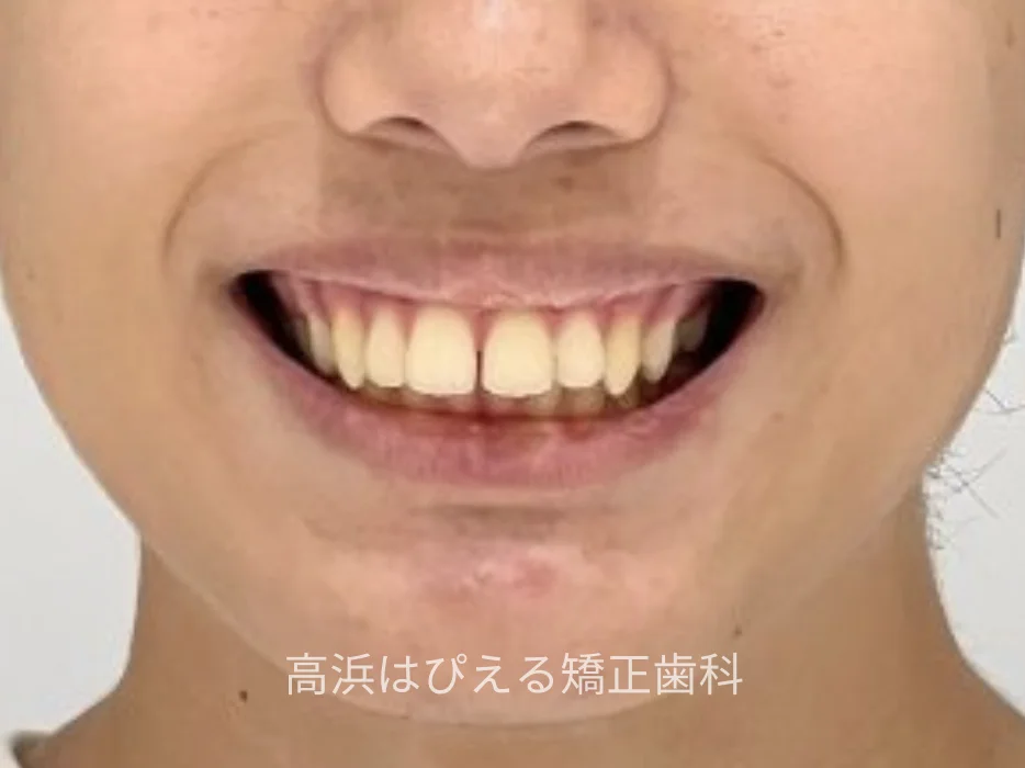 15歳男子の出っ歯・深い噛み合わせ症例の治療前の口元写真