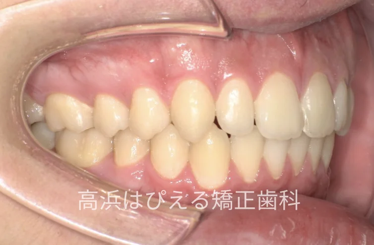 15歳男子の出っ歯・深い噛み合わせの治療後の右側面口腔内写真
