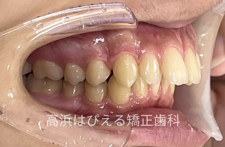 15歳男子の出っ歯・深い噛み合わせの治療前の右側面口腔内写真