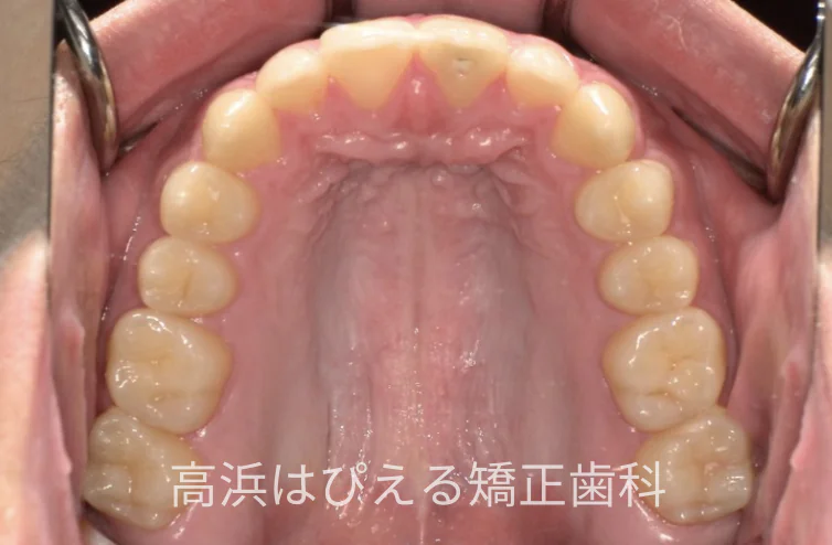 15歳男子の出っ歯・深い噛み合わせ症例の治療後の上顎咬合面口腔内写真