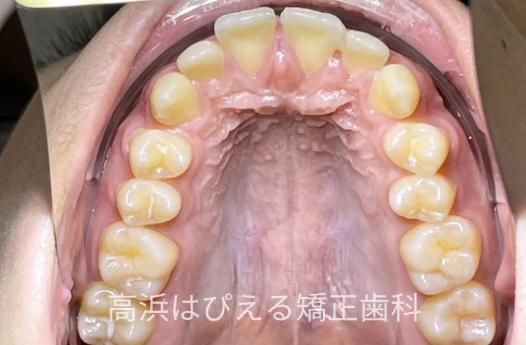 15歳男子の出っ歯・深い噛み合わせ症例の治療前の上顎咬合面口腔内写真