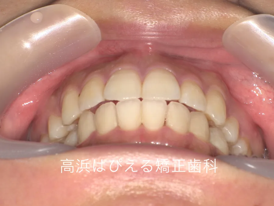 出っ歯・口元の突出症例の治療後の正面口腔内写真。上下の前歯の位置関係が整った状態