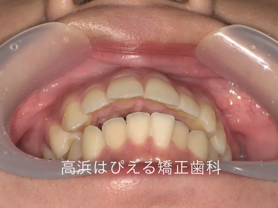 出っ歯・口元の突出症例の治療前の正面口腔内写真。上の前歯が下の前歯より大きく前に出ている状態