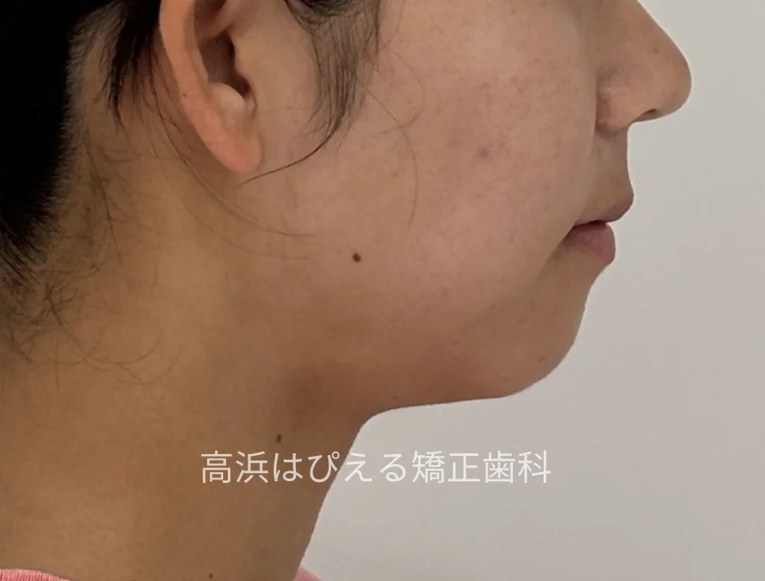 出っ歯・口元の突出症例の治療後の横顔写真