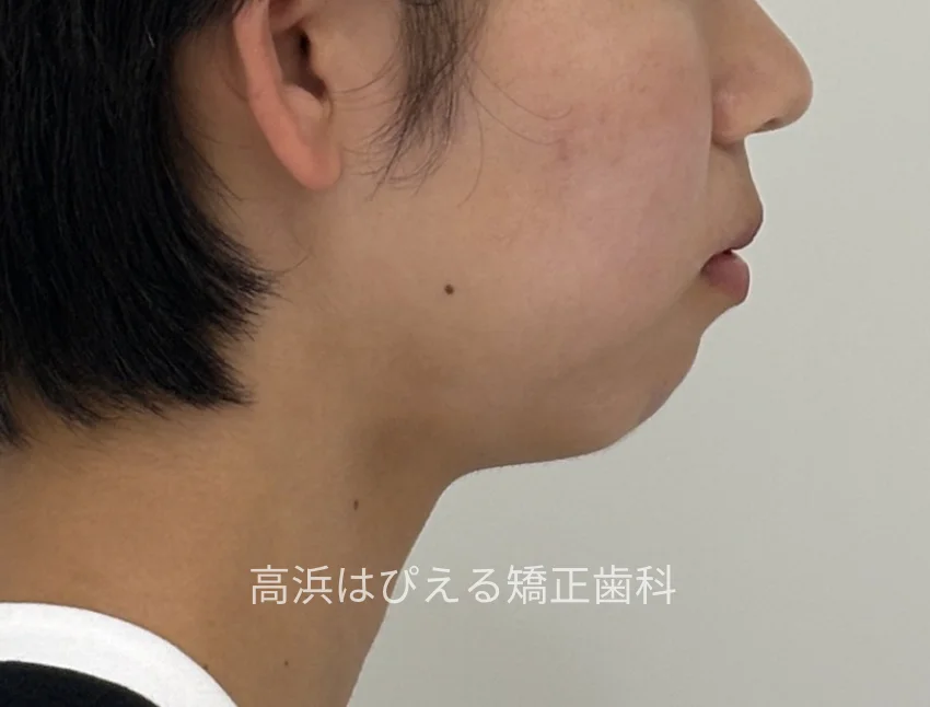 出っ歯・口元の突出症例の治療前の横顔写真