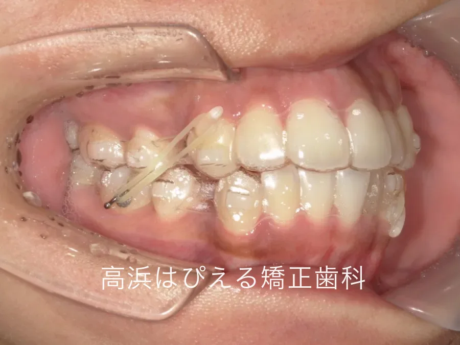 装置装着中の右側面口腔内写真。抜歯したすき間にゴムをかけて前歯を後方へ動かしている状態