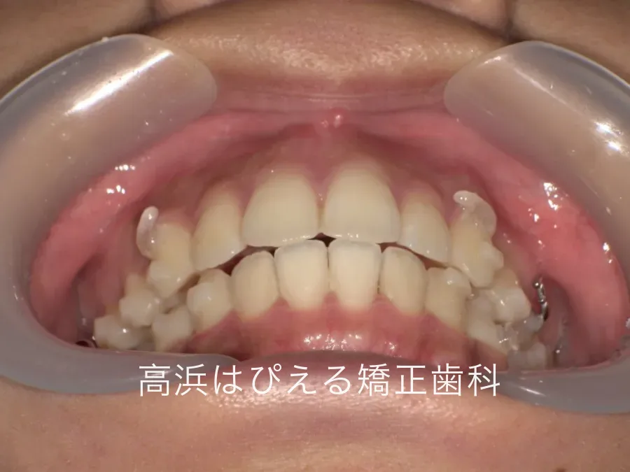 治療開始13ヶ月時点の正面口腔内写真。前歯が後方へ移動してきた状態