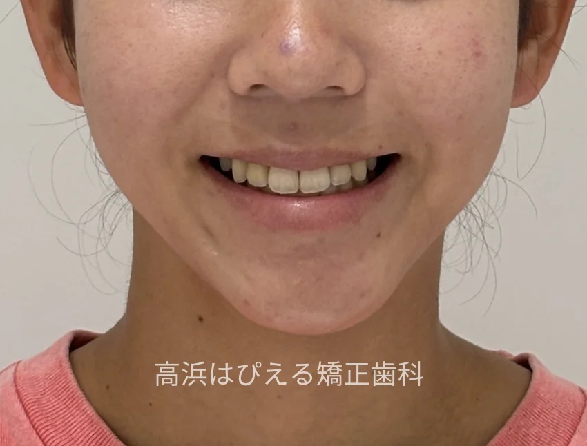 出っ歯・口元の突出症例の治療後の正面スマイル写真