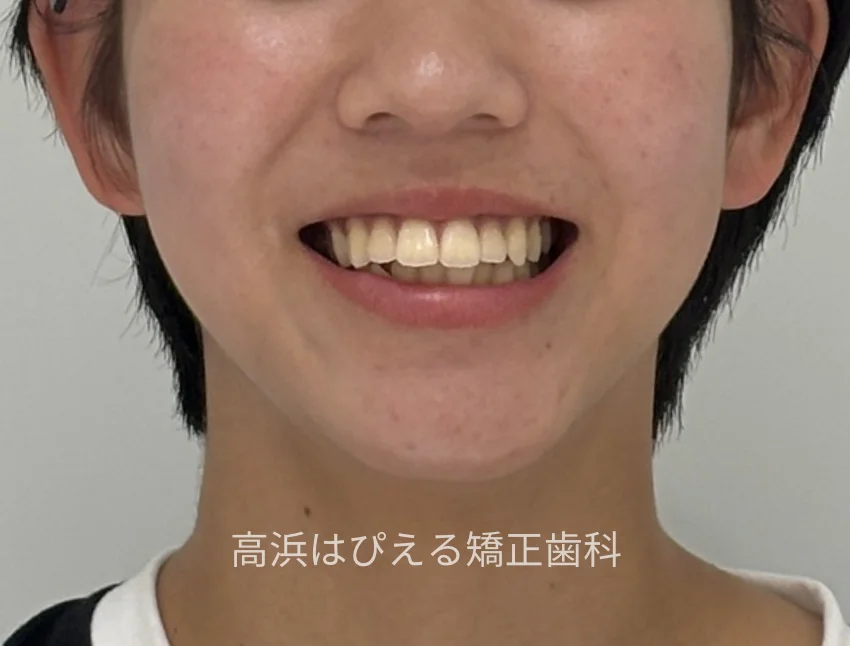 出っ歯・口元の突出症例の治療前の正面スマイル写真