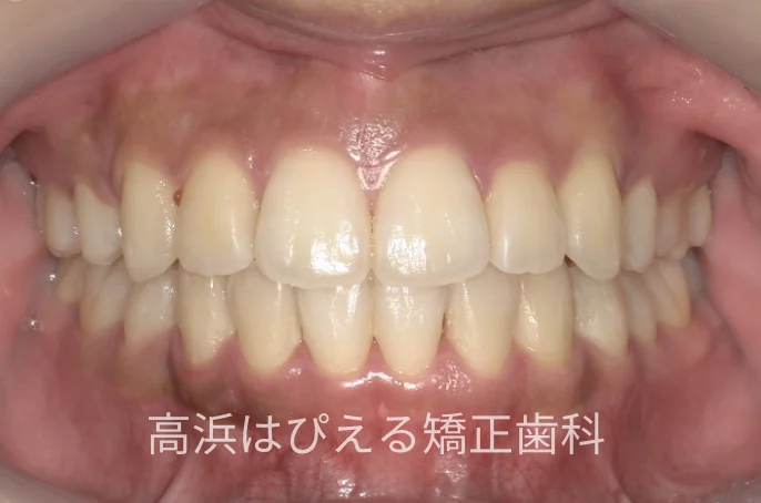 出っ歯・口元の突出症例の治療後の正面口腔内写真