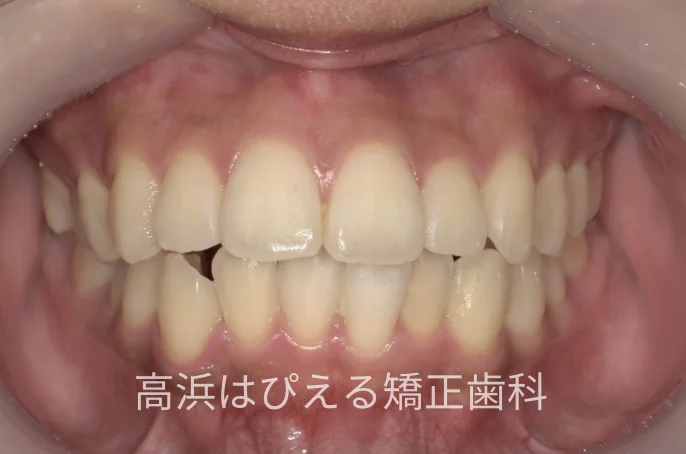 出っ歯・口元の突出症例の治療前の正面口腔内写真