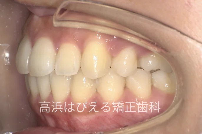 出っ歯・口元の突出症例の治療後の左側面口腔内写真