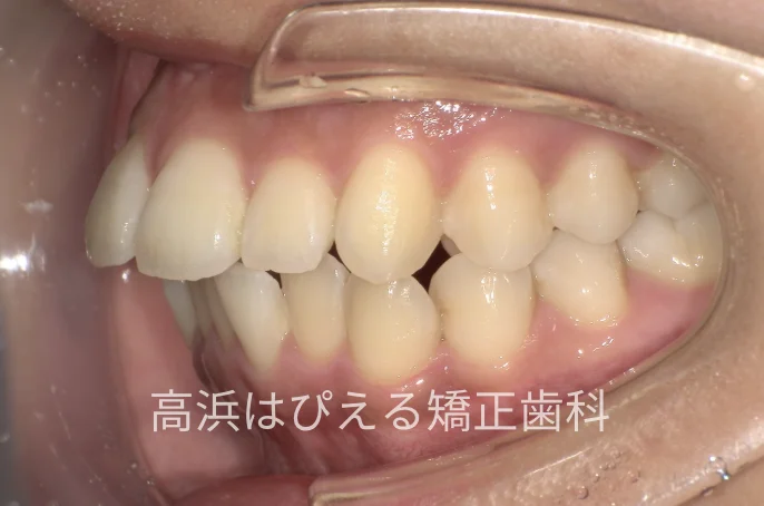 出っ歯・口元の突出症例の治療前の左側面口腔内写真