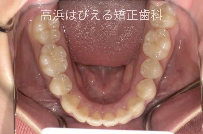 出っ歯・口元の突出症例の治療後の下顎咬合面写真