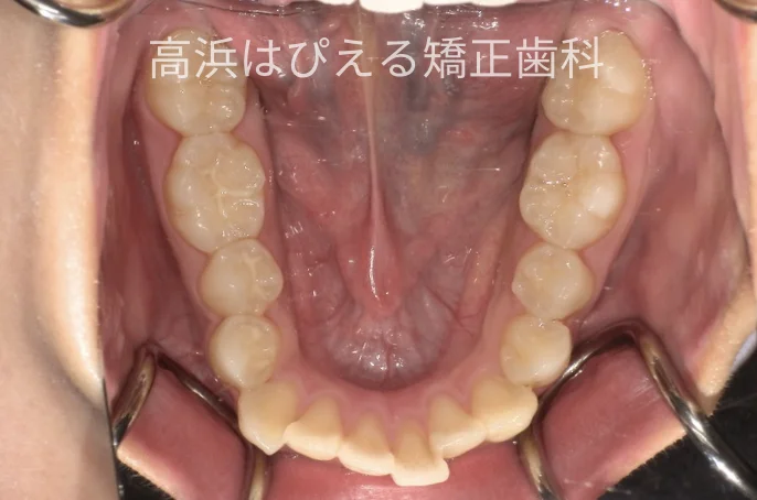 出っ歯・口元の突出症例の治療前の下顎咬合面写真