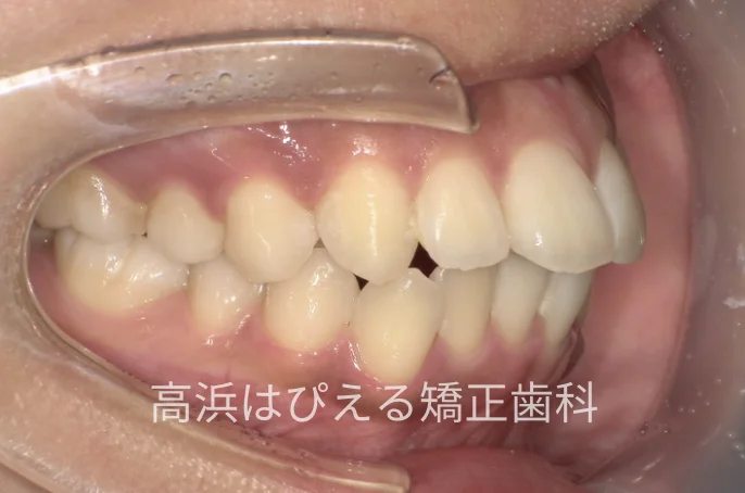出っ歯・口元の突出症例の治療前の右側面口腔内写真