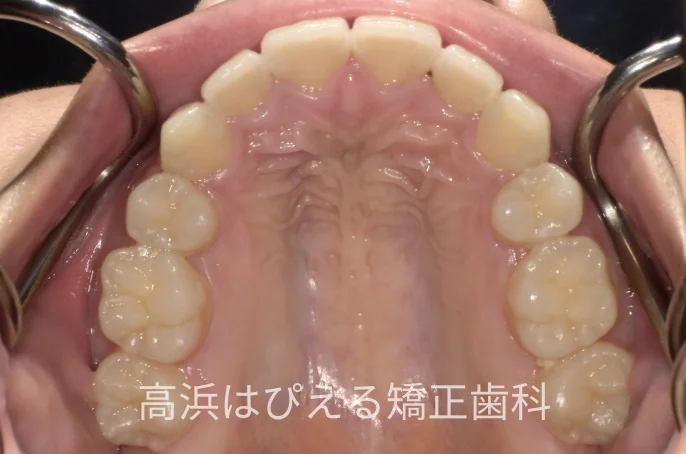 出っ歯・口元の突出症例の治療後の上顎咬合面写真