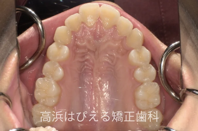 出っ歯・口元の突出症例の治療前の上顎咬合面写真