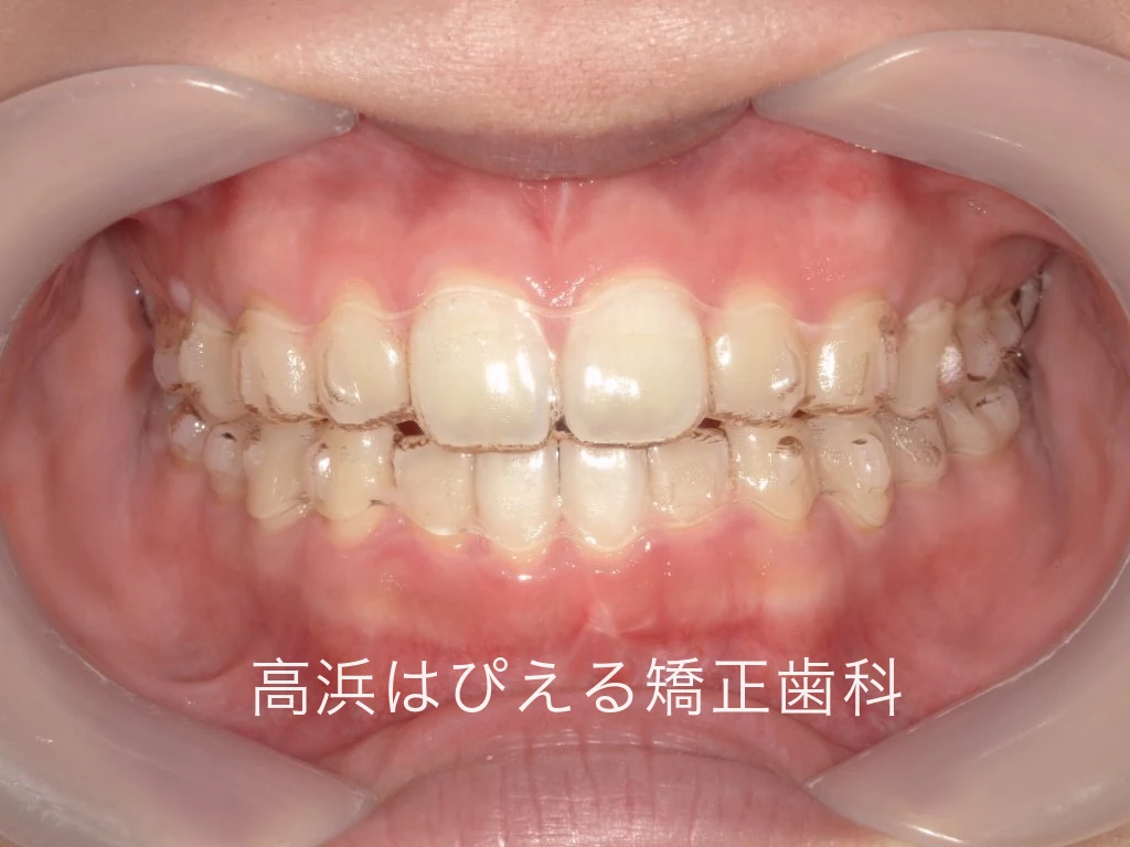 すきっ歯症例のマウスピース型矯正装置を装着した正面口腔内写真