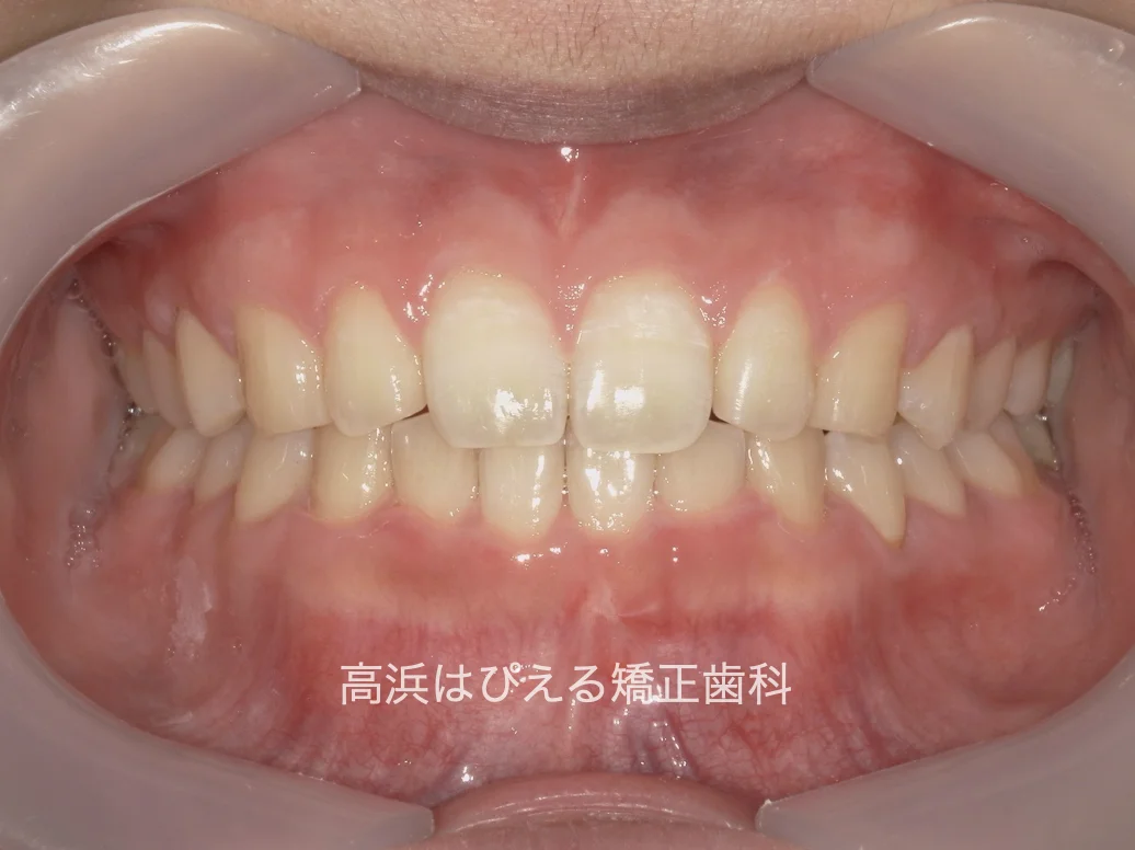 すきっ歯症例の治療後の正面口腔内写真