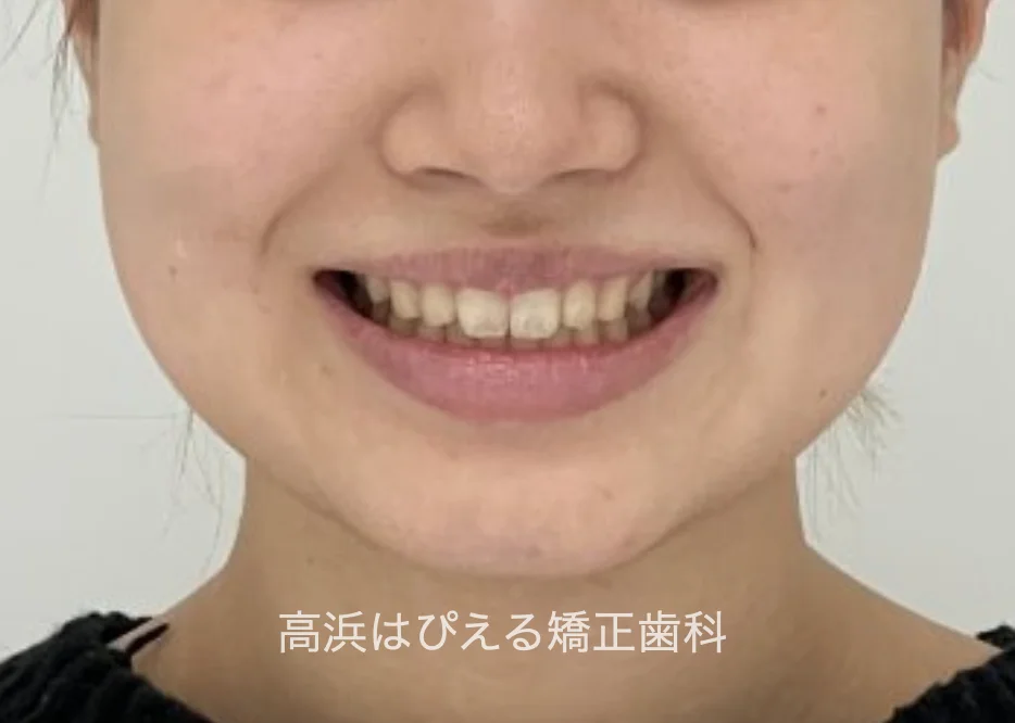 すきっ歯症例の治療後の口元写真