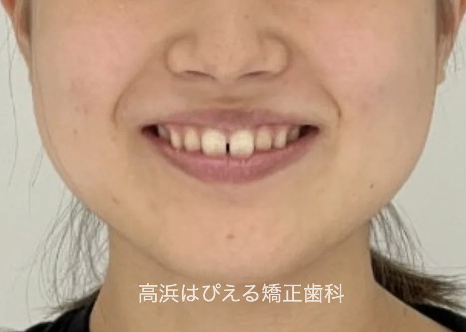 すきっ歯症例の治療前の口元写真