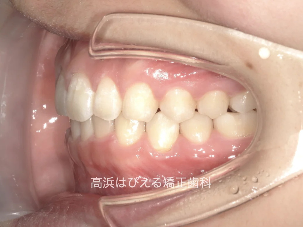 すきっ歯症例の治療後の左側面口腔内写真