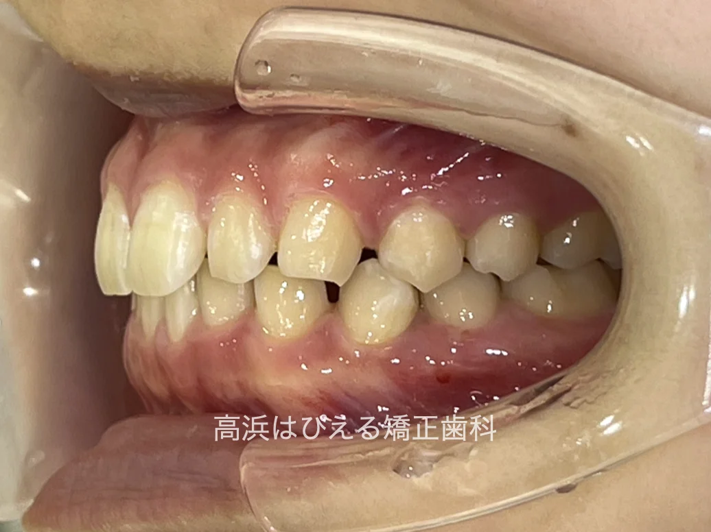 すきっ歯症例の治療前の左側面口腔内写真