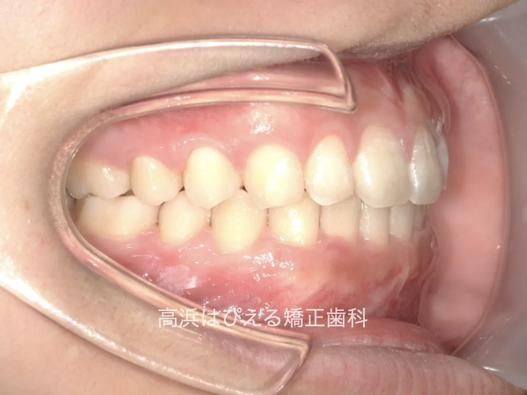 すきっ歯症例の治療後の右側面口腔内写真