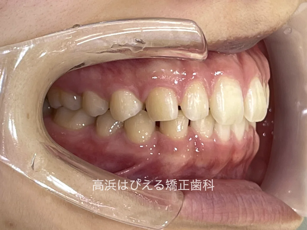 すきっ歯症例の治療前の右側面口腔内写真