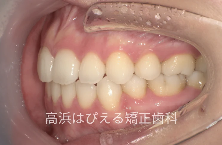 18歳女性の受け口（切端咬合）症例の治療後の左側面口腔内写真