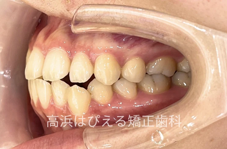 18歳女性の受け口（切端咬合）症例の治療前の左側面口腔内写真