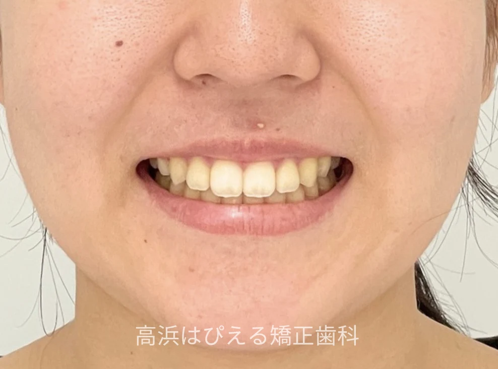 18歳女性の受け口（切端咬合）症例の治療後の口元写真