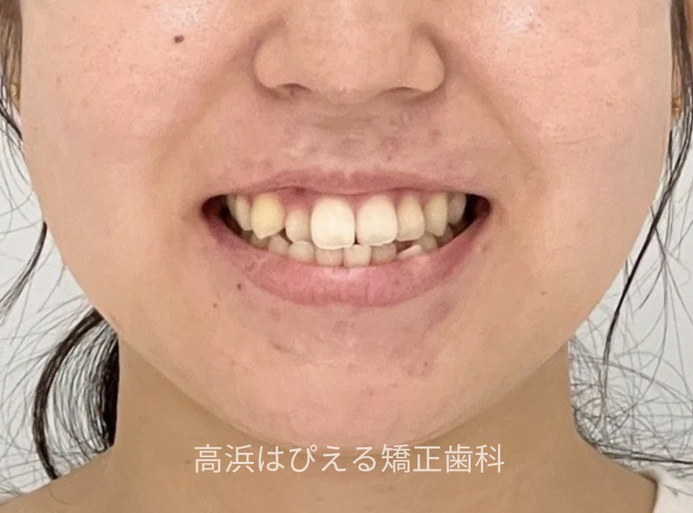 18歳女性の受け口（切端咬合）症例の治療前の口元写真
