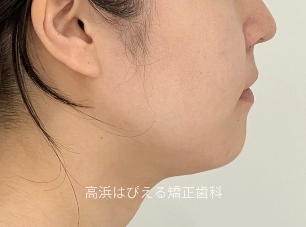 18歳女性の受け口（切端咬合）症例の治療後の横顔写真